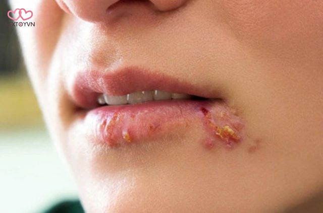 Quan hệ bằng miệng có thể mắc các bệnh lây truyền qua đường tình dục